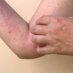 Monkey,Pox,Virus,,A,New,World,Problem,Of,Modern,Humanity.